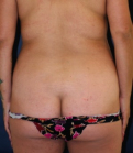 Feel Beautiful - Liposuction Back-Waist 207 - Before Photo